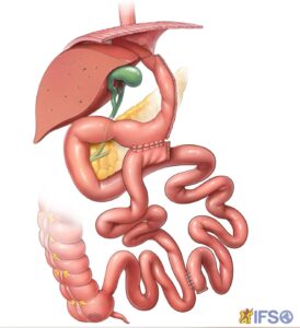 Bipartição do Trânsito Intestinal